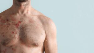 މަކުނުވިދުރި ބަލީގެ ފުރަތަމަ ކޭސް ޖަޕާނުން ފެނިއްޖެ