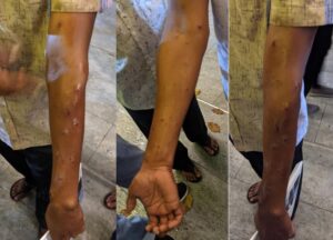ހަށިފާރަވެރިންނަށްވެސް ބޮޑެތި ޒަޚަމްތަކެއް، ފަރުވާއަށްފަހު ދޫކޮށްލައިފި