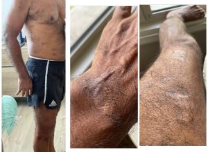 ނަޝީދަށް ލިބިފައިވާ އަނިޔާތައް ފެންނަ އިތުރު ފޮޓޯތަކެއް ހިއްސާކޮށްފި