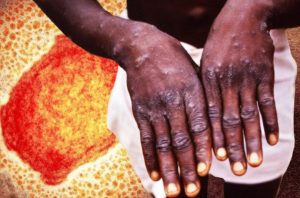 މަންކީޕޮކްސް ފެތުރުމުގެ ފުރުސަތު ކުޑަނަމަވެސް ރާއްޖެއަށް ބަލި އައުމަކީ އެކަށީގެންވާކަމެއް: އެޗްޕީއޭ