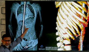 އޭޑީކޭއިން އަޖައިބެއްފަދަ ސާޖަރީއެއް، ފުރާނަ ސަލާމަތްވީ 9 ގަޑިއިރުގެ މަސައްކަތުން!