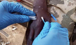 އެމްޕޮކްސްގެ ގްލޯބަލް ސިއްހީ އިމަޖެންސީ ހާލަތު ޑަބްލިއުއެޗްއޯއިން އުވާލައިފި